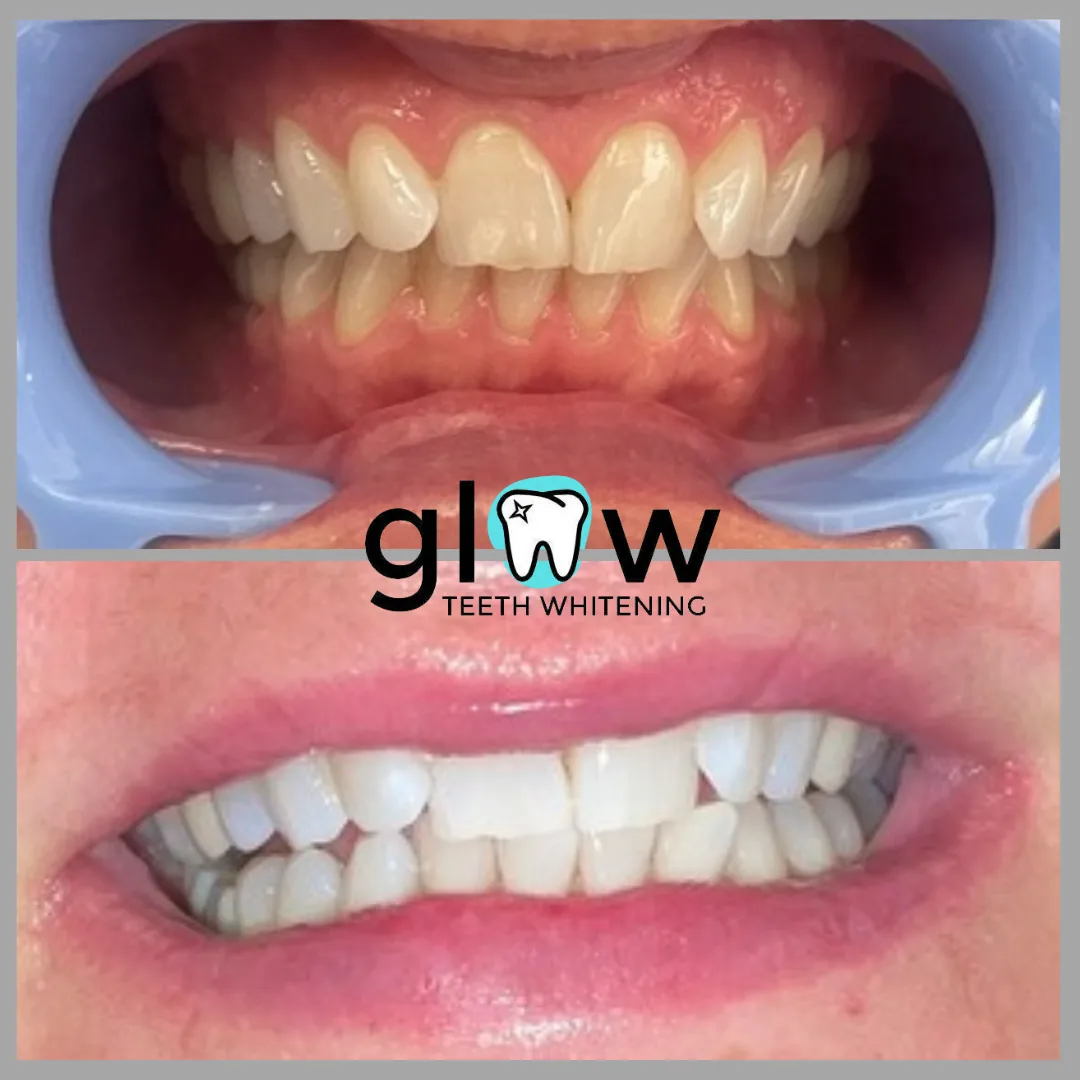 Glow Teeth Whitening